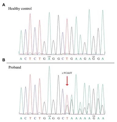 Identification of a Novel Pathogenic Folliculin Variant in a Chinese Family With Birt–Hogg–Dubé Syndrome (Hornstein-Knickenberg Syndrome)